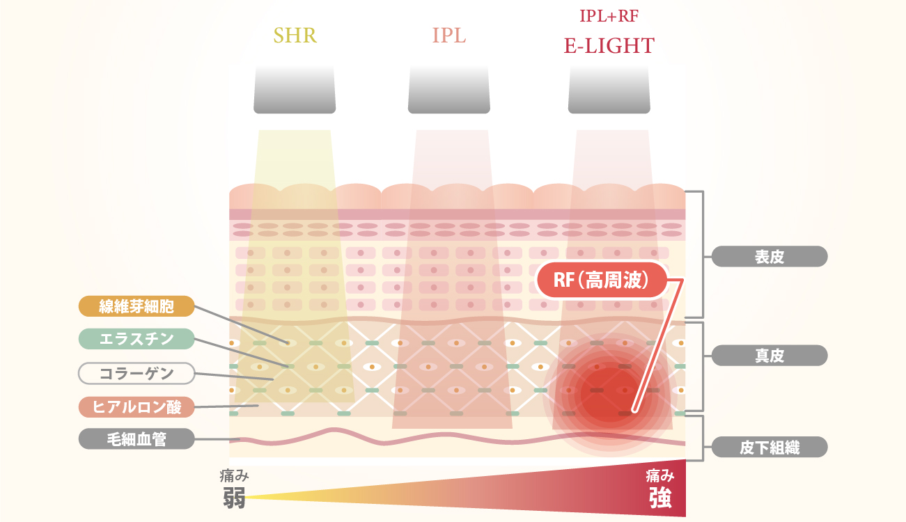 SHR・IPL・E-lightフェイシャルの違い_02