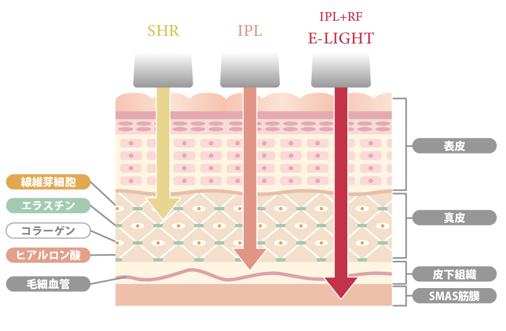 SHR・IPL・E-lightフェイシャルの違い_02