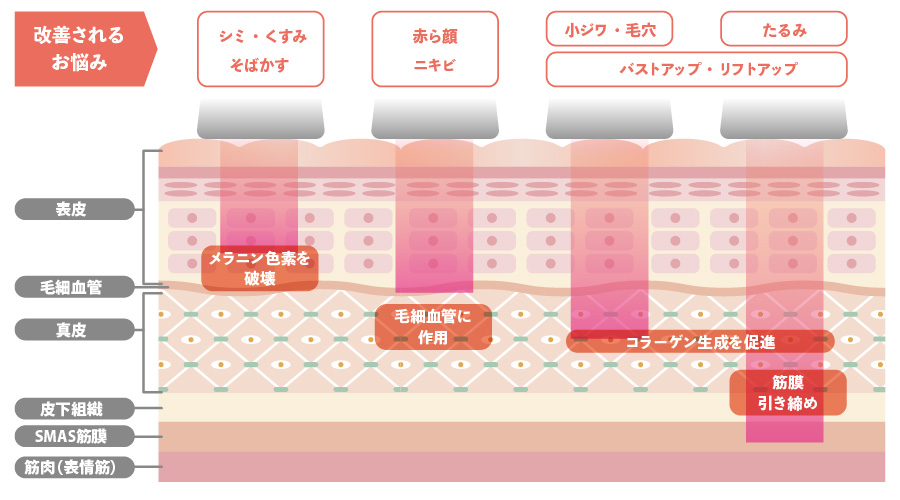 SHR・IPL・E-lightフェイシャルの違い_02