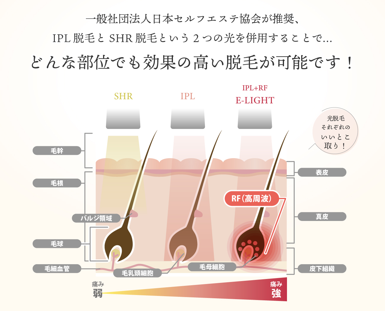 一般社団法人日本セルフエステ協会が推奨、IPL脱毛とSHR脱毛という2つの光を併用することで、どんな部位でも効果の高い脱毛が可能です！