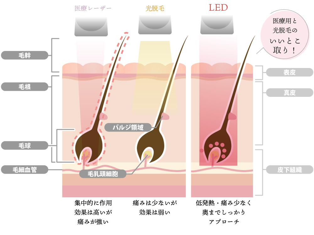 LED脱毛と従来の脱毛の違い