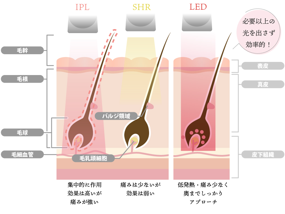 LED脱毛とSHR・IPL脱毛の違い